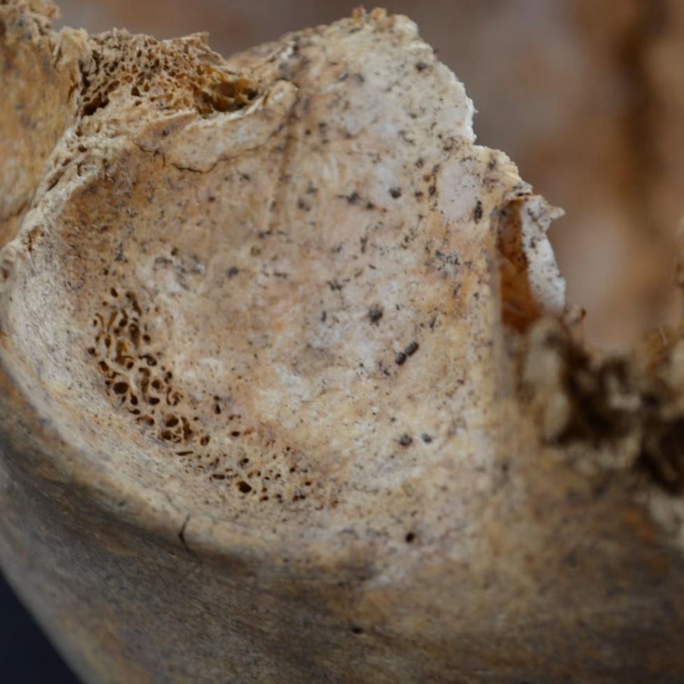 Picture of a porous cranial lesion 